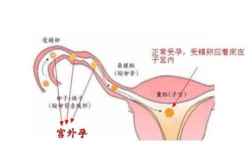 肚子又胀又痛, 当心宫外孕 宫外孕有何症状?