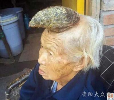 87岁老妇头上黑痣长成"独角"时时发痒流血